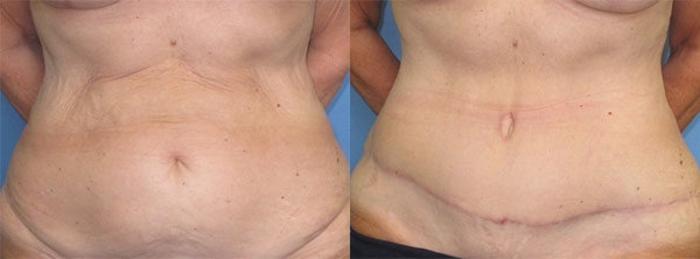 Before & After Tummy Tuck Case 32 Front View in Charleston, SC