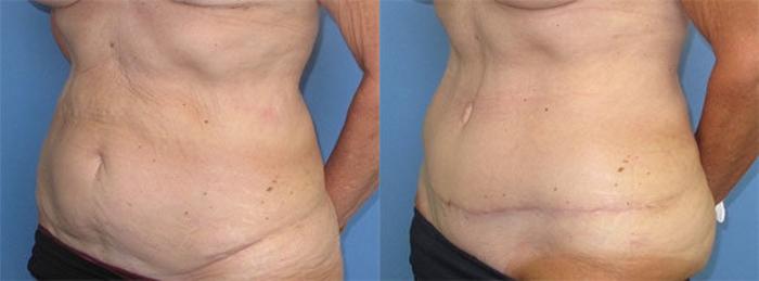 Before & After Tummy Tuck Case 32 Left Oblique View in Charleston, SC