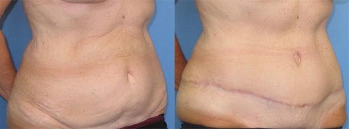 Before & After Tummy Tuck Case 32 Right Oblique View in Charleston, SC