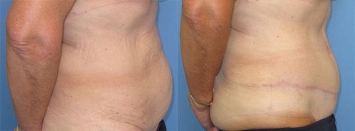 Before & After Tummy Tuck Case 32 Right Side View in Charleston, SC