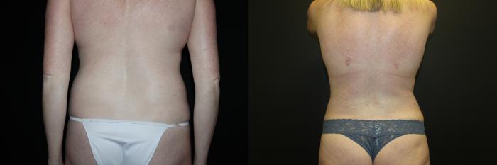 Before & After Tummy Tuck Case 93 Back View in Charleston, SC
