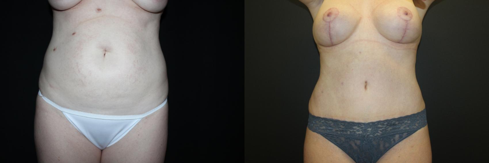 Before & After Tummy Tuck Case 93 Front View in Charleston, SC