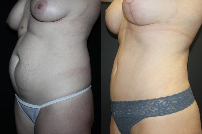 Before & After Liposuction Case 93 Left Oblique View in Charleston, SC
