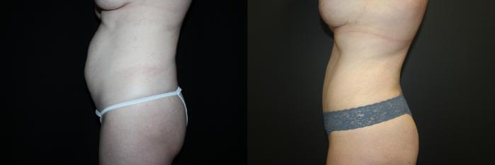 Before & After Tummy Tuck Case 93 Left Side View in Charleston, SC
