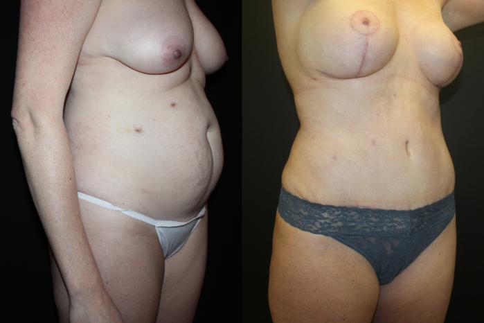 Before & After Liposuction Case 93 Right Oblique View in Charleston, SC
