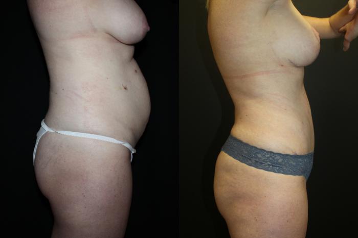 Before & After Liposuction Case 93 Right Side View in Charleston, SC